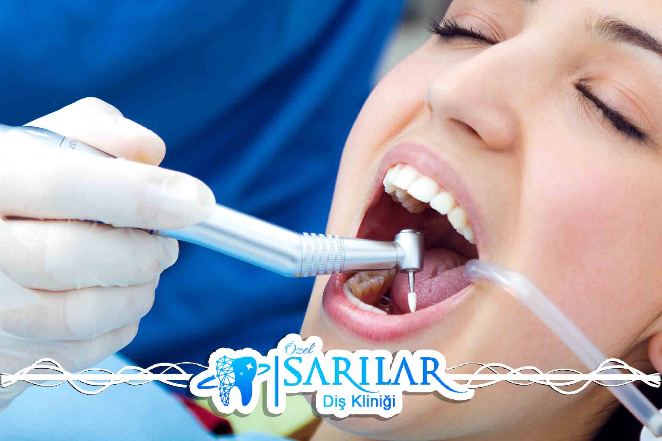 Manavgat Diş Kliniği Endodonti Tedavi – Özel Sarılar Diş Kliniği